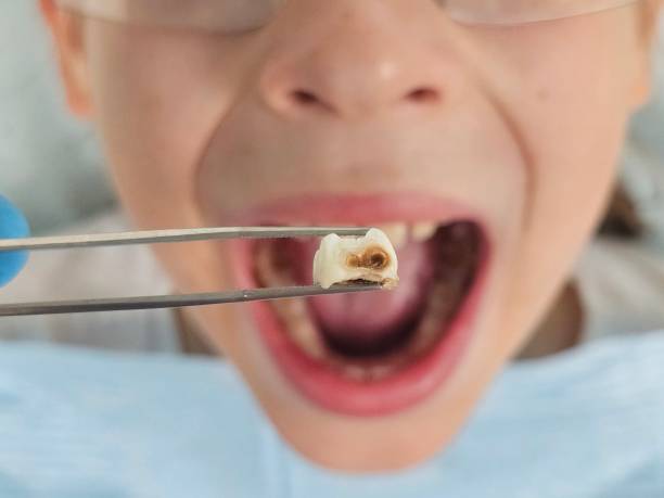 Best Urgent Tooth Repair  in West Hill, OH